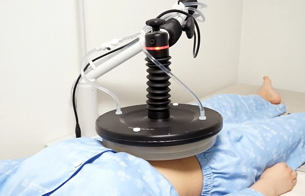 복부 고주파 치료