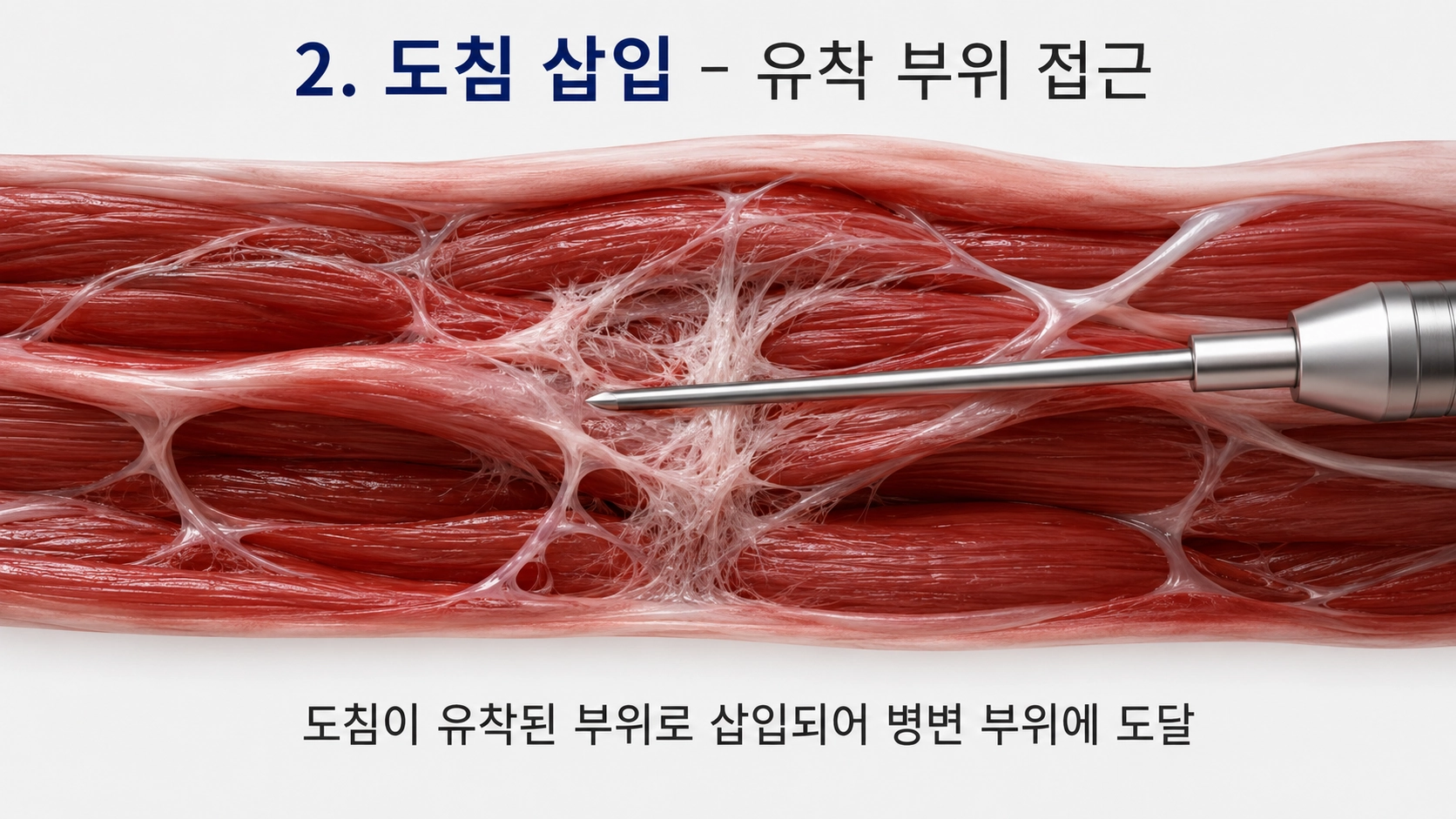 도침 삽입