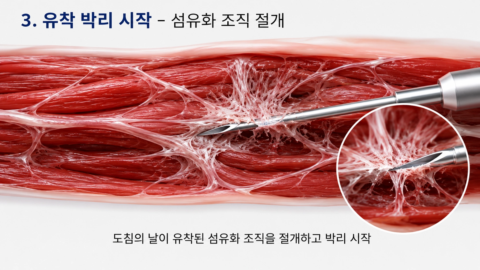 유착 박리 시작