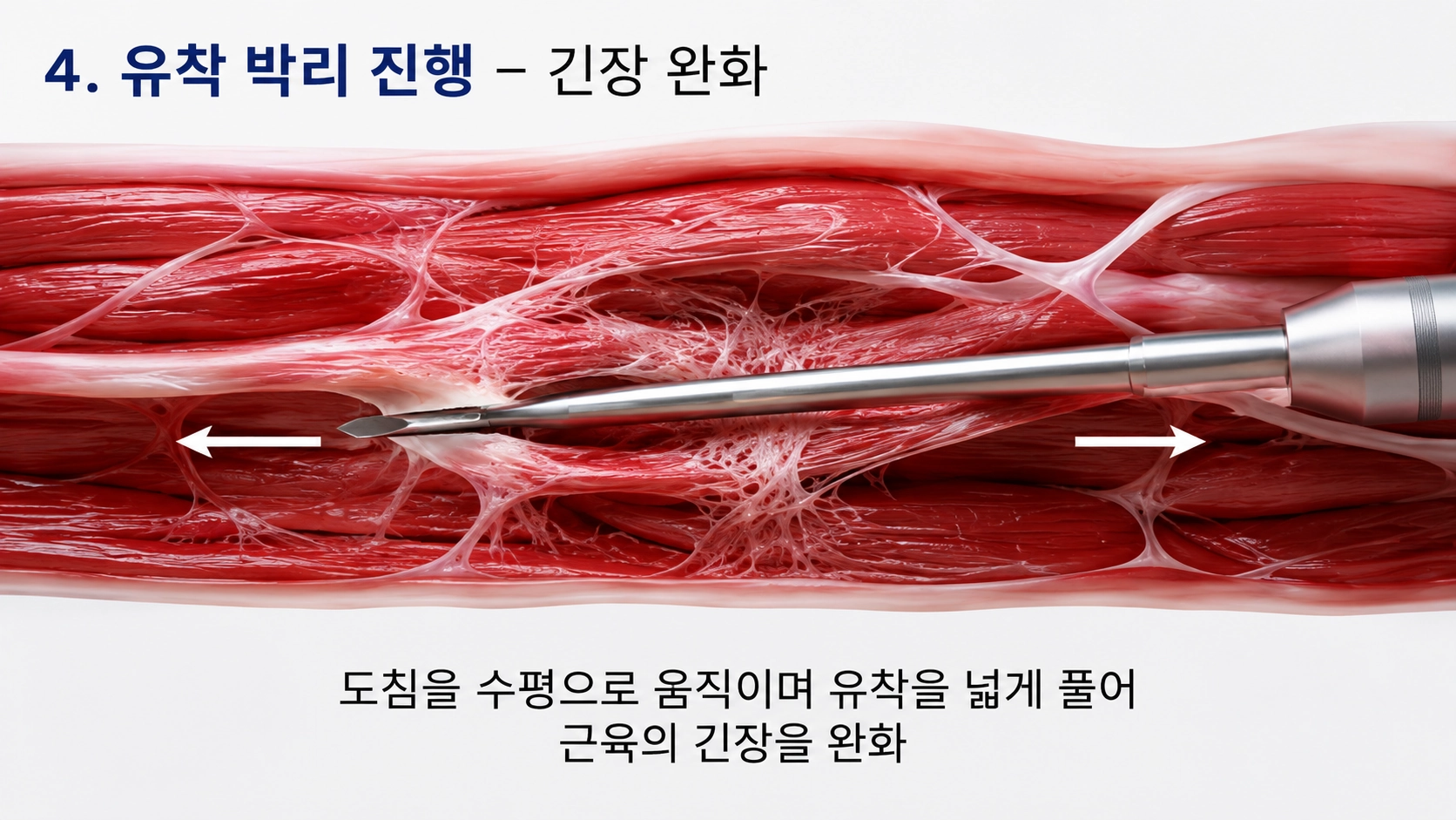유착 박리 진행