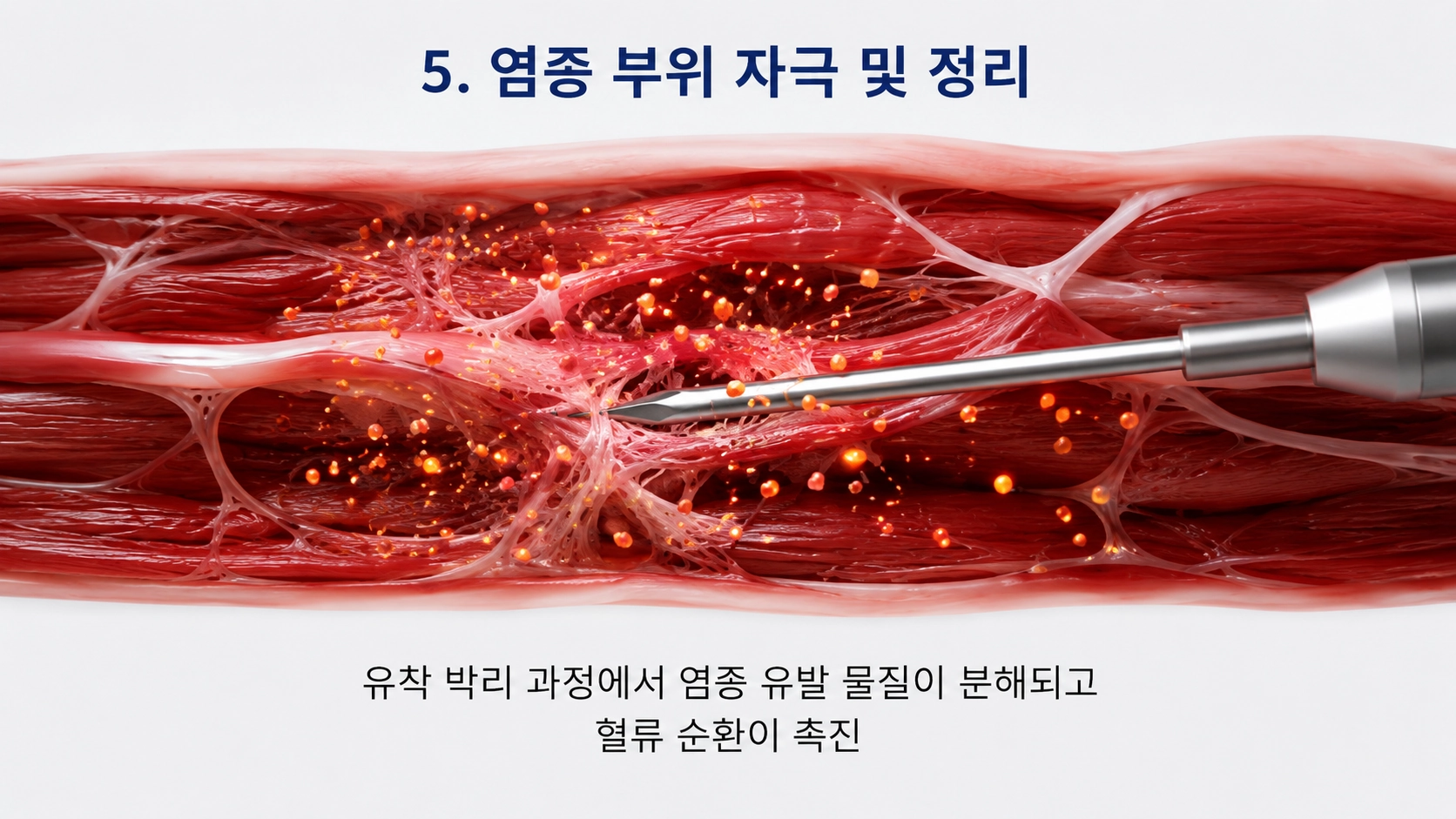 염증 부위 자극 및 정리