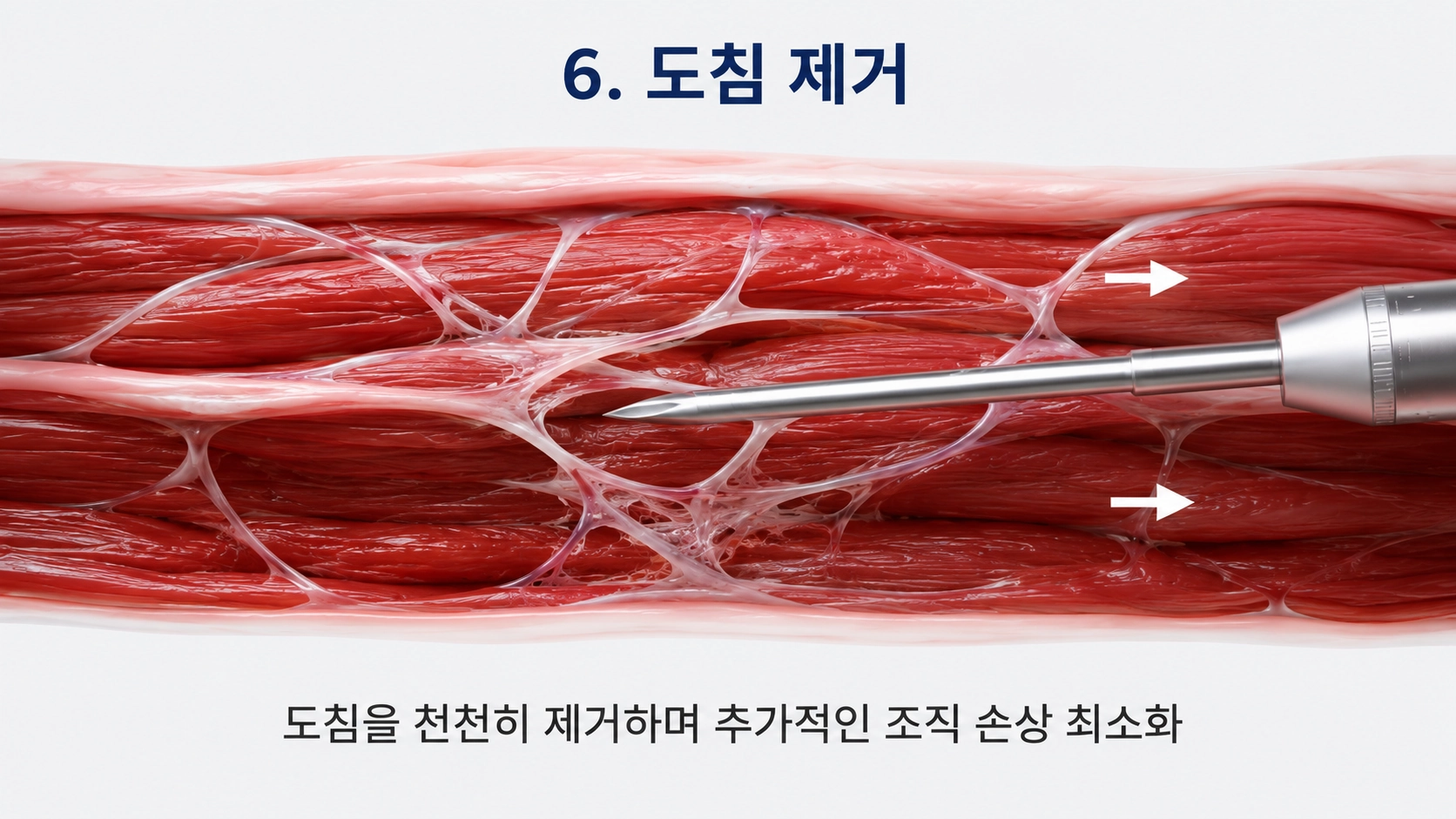 도침 제거